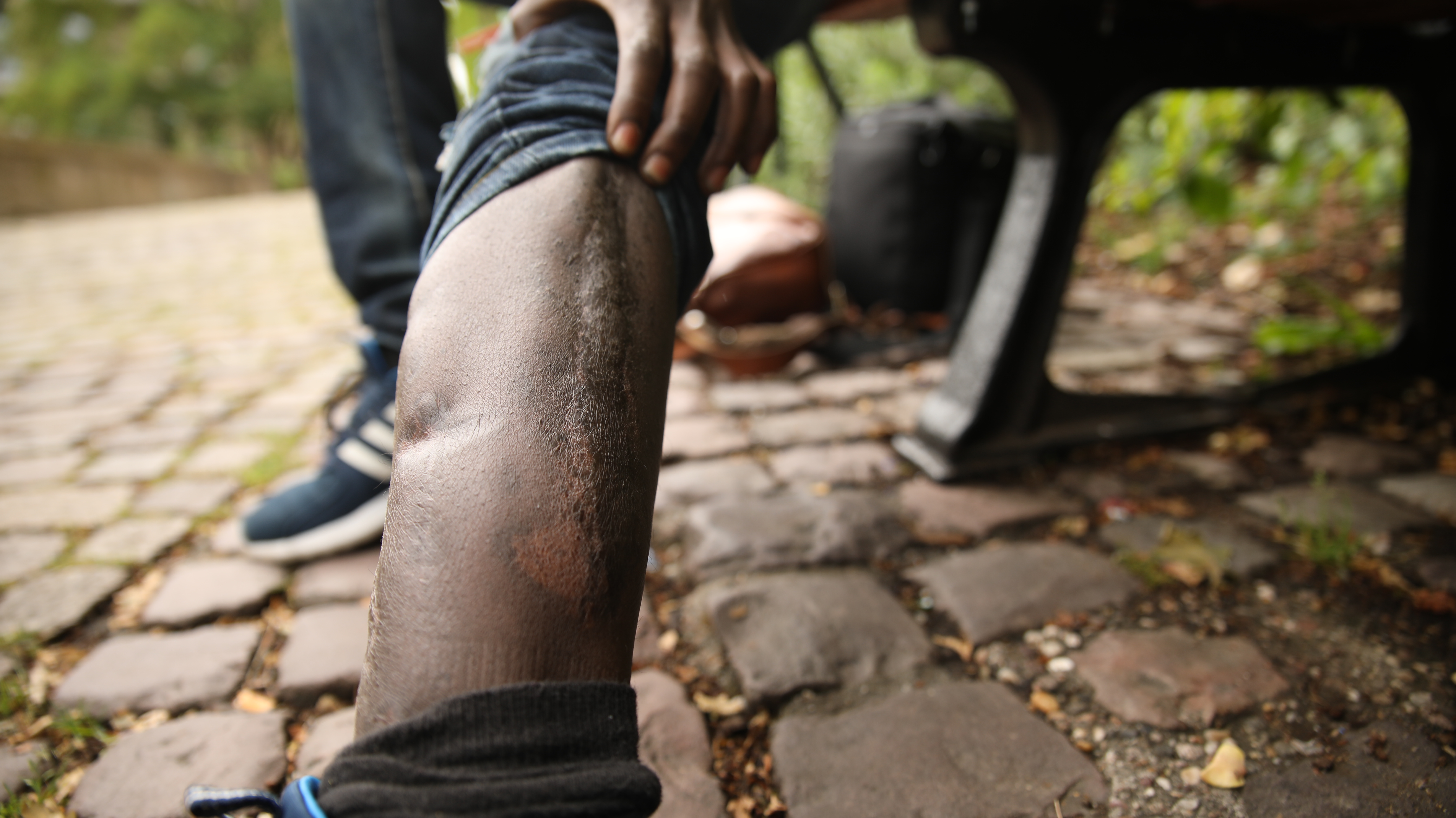 Mineurs isolés, la double peine - Semaï, jeté à la rue avec sa jambe tordue (1/2)
